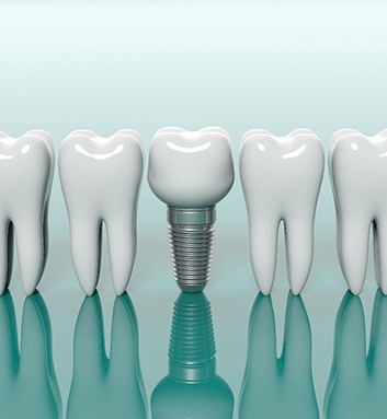 dental implant in a row of teeth 