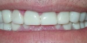 Beautiful healthy smile after treatment