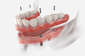 Model of implant denture on the lower jaw