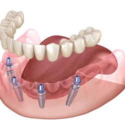 Diagram showing how implant dentures work