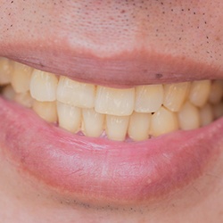 A closeup of a patient with a dirty, stained smile