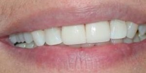 perfectly aligned smile after treatment