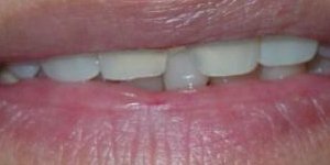 gap between front teeth before treatment