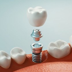 Digital image of a dental implant and its three main parts