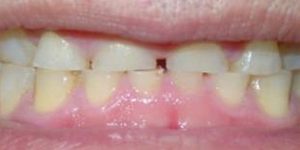 Short stubby teeth before treatment