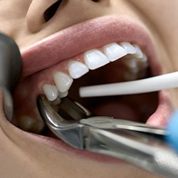 A model comparing tooth extraction and root canal treatment options