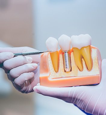 The four step dental implant process is worth the time investment