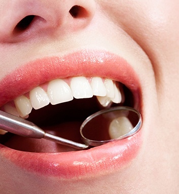 Closeup of a perfect smile being examined with dental mirror
