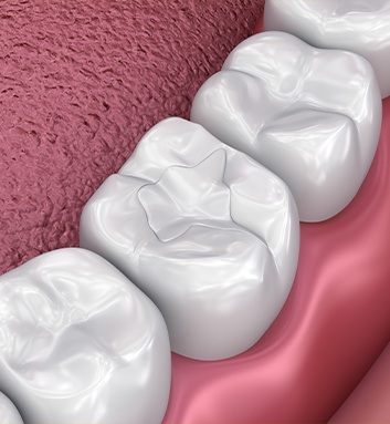 illustration of tooth colored filling