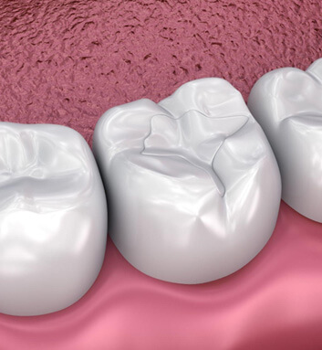 Model of a tooth-colored filling