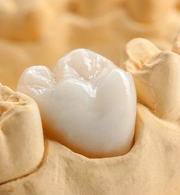 tooth colored fillings