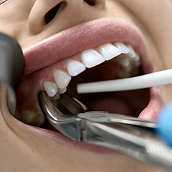 Dental forceps holding on a to-be-extracted tooth