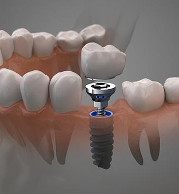 dental implant post, abutment, and crown being placed 