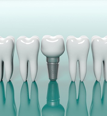 dental implant in a row of teeth