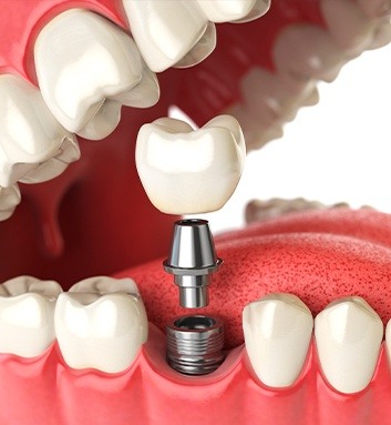 three piece dental implants