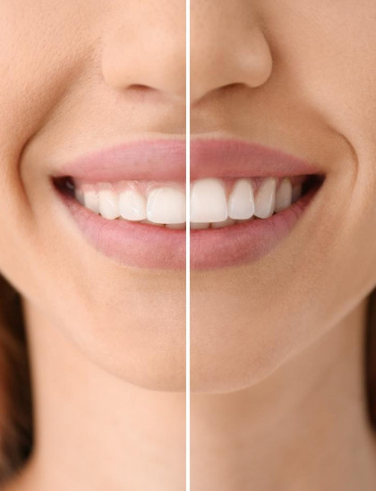 A woman before and after gum recontouring