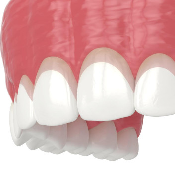 Before and after gum recontouring