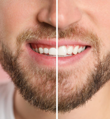 A man before and after gum recontouring