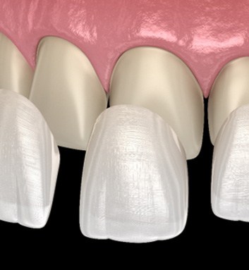 3 D illustration of veneers