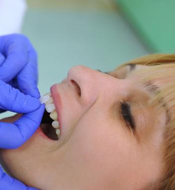 woman getting veneers