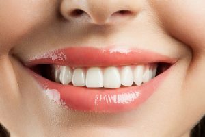 Your dentist in Fort Smith answers your questions about porcelain veneers.