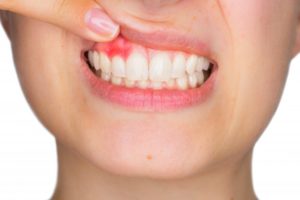 woman pink spot on gums