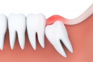 a wisdom tooth under the gum line